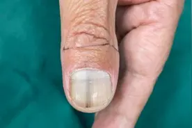指甲长出一条黑线，他有点慌：可能癌变吗？图片