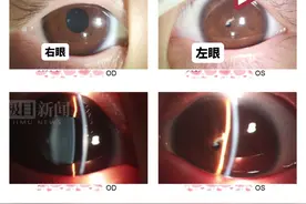 4岁女童先天没瞳孔，专家妙手来“点睛”图片