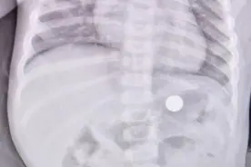 紧急！婴儿误吞电池，连州人医医生胃镜下妙手取出图片