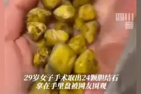 女生取24颗胆结石没事盘着玩 网友建议做成手串图片
