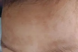 一哭闹就变红的额头小褐斑是什么？图片