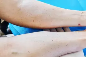 确诊了!很多人身上长的小红点，都是这个问题!中老年人尤其多见图片