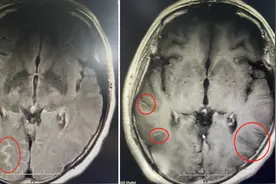 一天吃六颗止痛药都止不了头痛，竟因接触禽鸟图片