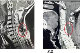 男子4米高处坠落险截瘫，医生精心救治助他站了起来图片