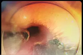 【健康连线】6岁男童误吞纽扣电池！道真自治县人民医院内镜中心紧急救治图片