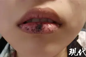 15岁女孩嘴唇上长黑痣肠子里长息肉，竟是得了罕见病图片