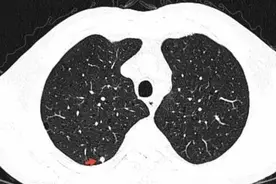 查出肺结节不要慌，这些事项你要知道→图片
