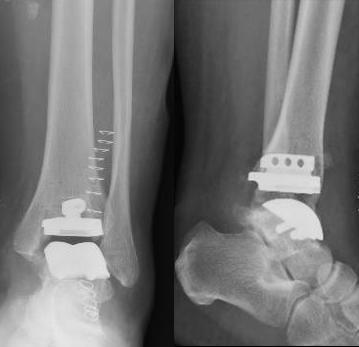 量“脚”定制！3D打印人工踝关节置换术为患者重塑“步履新生”