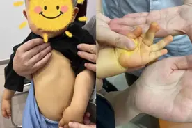 宝宝突变“小黄人”，妈妈懵了！医生：问题出在天天吃它图片