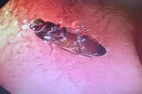 竟然没被消化？印度一医院称在患者小肠中发现3厘米长活蟑螂，幸被及时取出图片