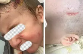 1岁萌娃突遭宠物狗扑咬！头面部多处撕裂紧急送医图片