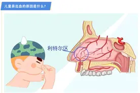 捉“谣”记｜孩子流鼻血，可以45度仰望天空？处理不当或“窒息”！图片