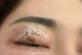 拍客｜女子眼部因隐翅虫液体残留致皮肤溃烂：灼烧刺痛，看东西模糊，望大家注意图片