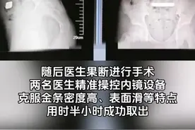 有娃必看！11岁男孩吞进100克金条，儿童意外伤害如何防范？图片