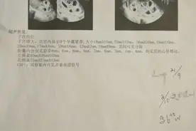 江西南昌一女子怀上9胞胎！就诊医院医生：最多保2个图片