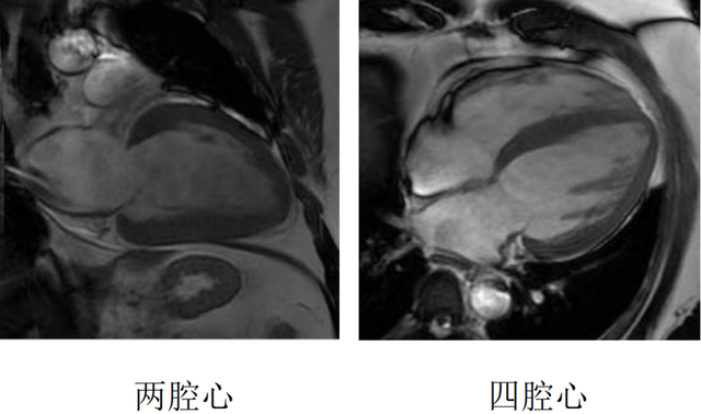 健康科普 | “一站式”心脏检查——心脏磁共振（CMR）
