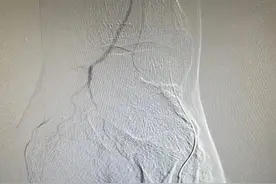 65岁糖足患者左足背大面积坏死 “脊髓电刺激”疗法助患者更好治愈图片