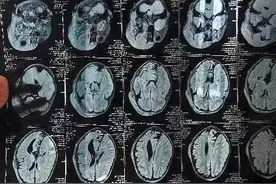 罕见人生｜牛奶咖啡斑和切不完的瘤，11岁的潼潼遭遇神经纤维瘤病图片