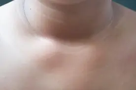 脖子上一圈黑线？警惕这种病！图片