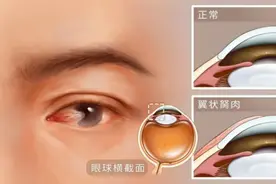 眼睛也要防晒？！忽视它导致黑眼球长出“小红肉”图片