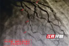 打嗝嗳气不是胃病竟是“心病”？警惕症状不典型冠心病图片
