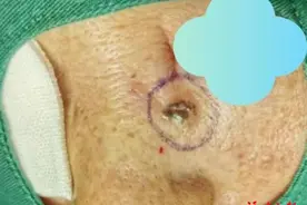 太吓人！脸上黑痣莫名出血，一查竟是癌图片