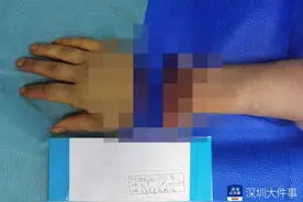 深圳一裁纸工人开工时右手手掌被切断，医生耗时近7小时接回图片