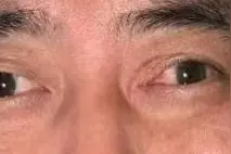 一朝解除35年斜视困扰，微创手术助患者“正视人生”图片