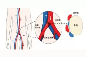 腿上青筋暴起，罪魁祸首竟是髂静脉压迫综合征图片
