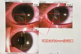 10岁哥哥被剪刀划破眼球 原是为了帮几个月的妹妹换纸尿裤图片
