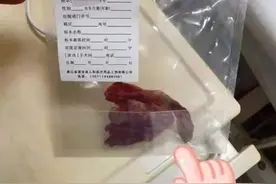 女子腹痛3年疑患肿瘤，手术后发现原是纱布留体内图片