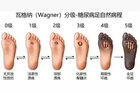 住院五次，截掉五根脚趾，原因是……图片