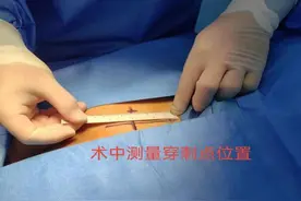 咸阳首例！西藏民族大学附属医院泌尿外科成功为患者安置“膀胱起搏器”图片