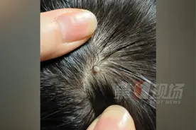 当心！逛完公园，这种“小黑点”钻进头皮……图片