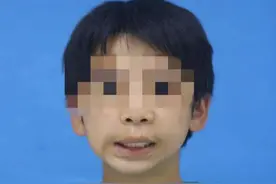 宁夏首例，14岁男孩靠3D打印重建下颌！图片