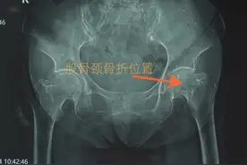 92岁老人大腿骨折，手术半个月康复可下地行走！图片
