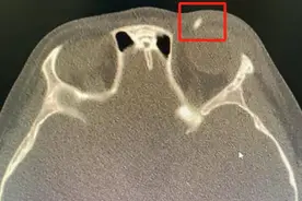 铅笔戳眼皮，六岁孩子发生意外，幸好医生及时取出图片