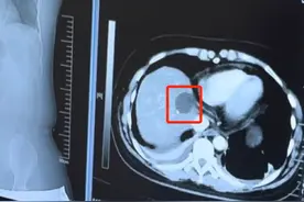 北京大学人民医院青岛医院肿瘤消融术为肿瘤患者提供更多选择图片