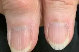 指甲上出现小白点真的是缺钙吗？真要担心的指甲是这样的……图片