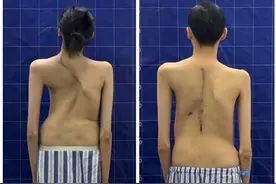 21岁驼背畸形女孩术后增高5厘米！湘雅二医院脊柱外科团队勇闯手术“禁区”图片