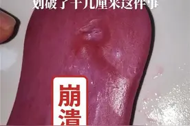 一个月内第二起？网友自称洗澡时被舒肤佳香皂内刀片划伤，品牌方回应图片