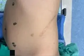 【朝医新闻】泌尿外科尿路修复团队5月内成功实施多例高难手术图片