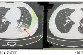吹了3天空调，一男子左肺“白”了一半！紧急提醒图片