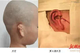 8岁男童天生右耳如“花生”，医生助其“重塑”耳朵图片