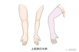 如何识别淋巴水肿早期征兆？图片