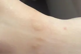 睡前打死10只！不少杭州人中招：“奇痒无比”！医生提醒图片