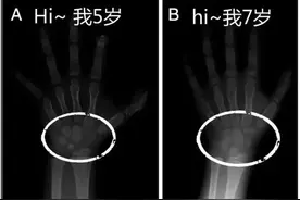 “测骨龄”是智商税？面对“身高焦虑” 超声测量有新招图片