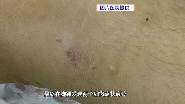 8岁男童昏迷9小时险丧命！医生靠脚踝俩小红点揪出“元凶”