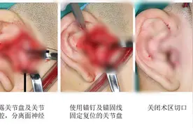 青岛首例！颞下颌关节盘锚固术“解救”有口难开图片