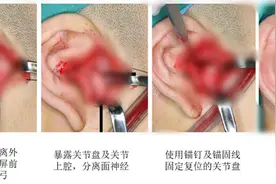 青岛首例！颞下颌关节盘锚固术“解救”有口难开图片